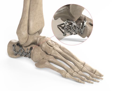 Компрессионная костная пластина для пяточной кости - Ases Orthopedics