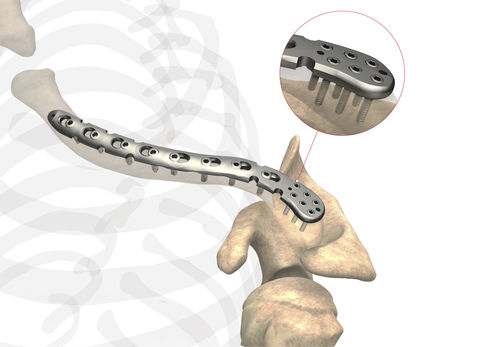 Компрессионная костная пластина для ключицы - Ases Orthopedics - дистальная / блокируемая