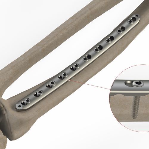 Компрессионная костная пластина лучевая кость - 1T12 series - Ases Orthopedics - дистальная / блокируемая