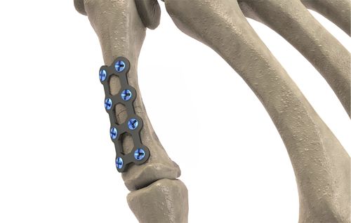 Компрессионная костная пластина пясть - 1T112-10061506 - Ases Orthopedics - блокируемая