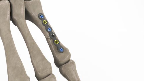 Компрессионная костная пластина пясть - 1T112-10092006 - Ases Orthopedics - блокируемая