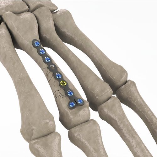 Компрессионная костная пластина пясть - 1T112-100102023 - Ases Orthopedics - блокируемая