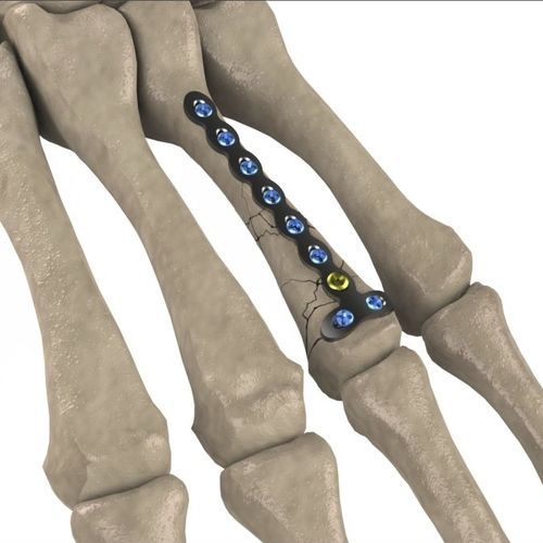 Компрессионная костная пластина пясть - 1T112-100112023 - Ases Orthopedics - блокируемая
