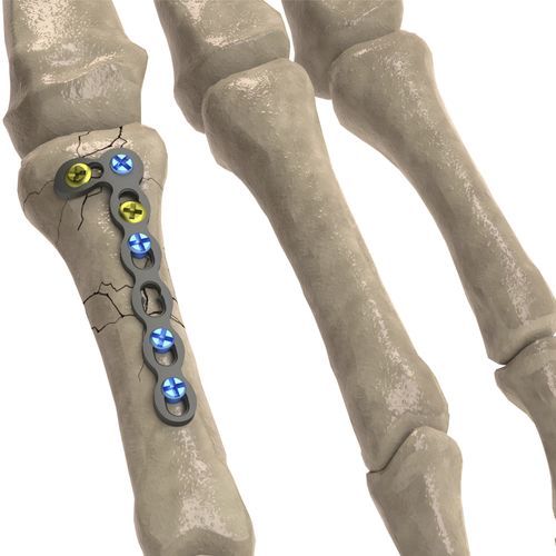 Компрессионная костная пластина для фаланги руки - 1T112-100242705L - Ases Orthopedics - блокируемая