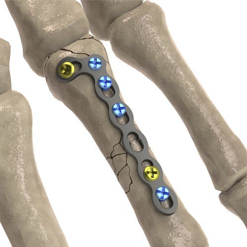 Компрессионная костная пластина для фаланги руки - LCP Oblique L - Ases Orthopedics - блокируемая