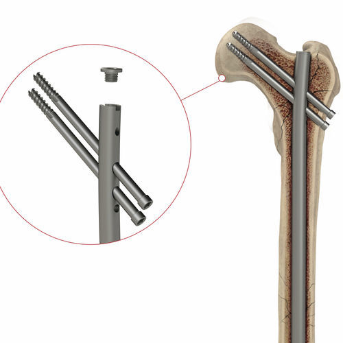 Интрамедуллярный штифт бедренная кость - 4T1-4001050 - Ases Orthopedics - проксимальная фиксация