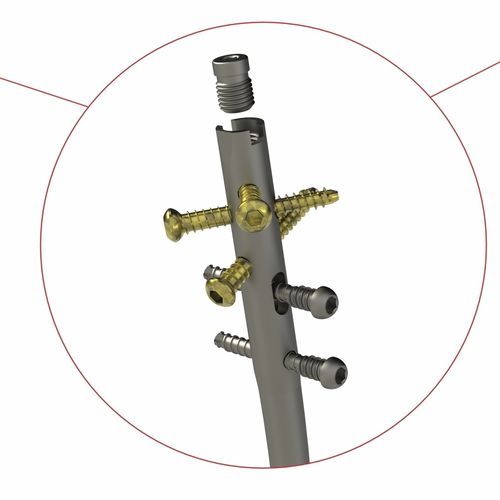 Интрамедуллярный штифт большеберцовая кость - 4T1-4011000 - Ases Orthopedics