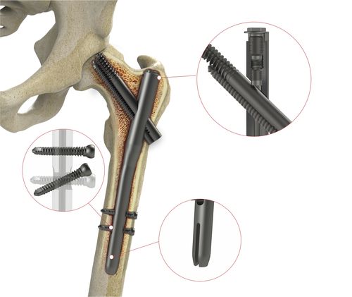 Интрамедуллярный штифт бедренная кость - 4T1-40310170 - Ases Orthopedics - проксимальная фиксация