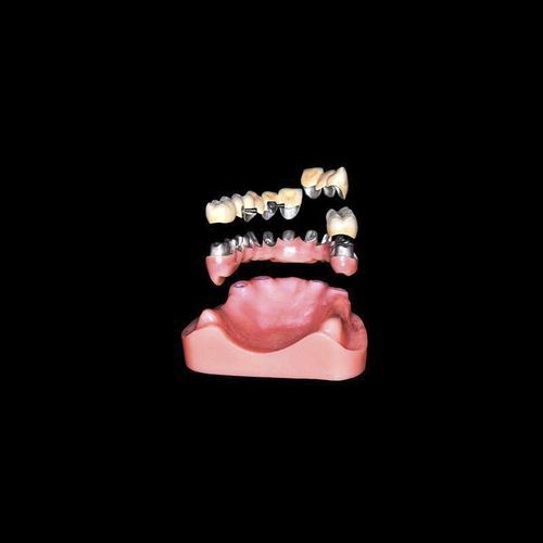 Цилиндрический конический зубной имплантат - Shenzhen Alcadent Co.Ltd Alcadent Dental Laboratory - из металла / прямой / для стоматологической лаборатории