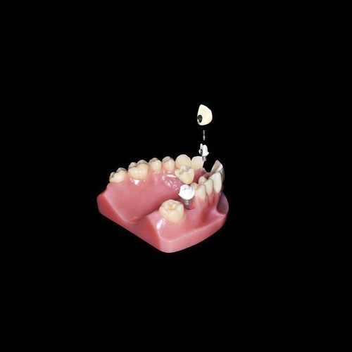 Абатмент из титана - Shenzhen Alcadent Co.Ltd Alcadent Dental Laboratory - циркониевый / из ПЭЭК / внутренний