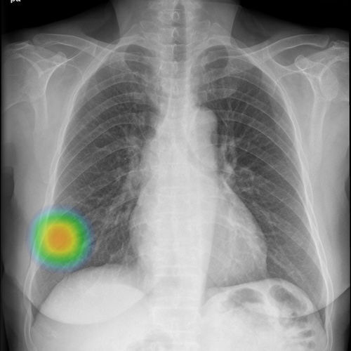 Программное обеспечение рентгенографии - INSIGHT CXR - Lunit - медицинское / для диагностики / легкого
