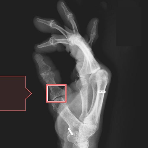Программное обеспечение для обнаружения переломов - RBfracture™ - Radiobotics - медицинское / для неотложной помощи / для рентгенологии