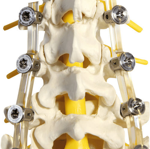 Система остеосинтеза для поясничной зоны - SpineShape System IV - SpineSave - через задний отдел