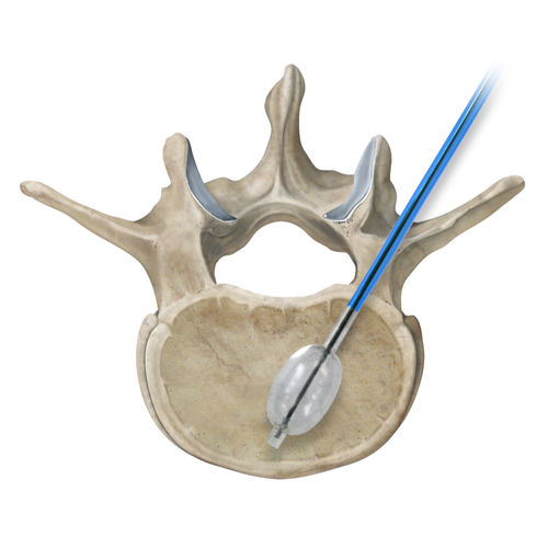 Инструмент для вертебропластики балонный катетер - Osteo-Site®  - IZI Medical - игольчатый / фреза / для чрескожной вертебропластики