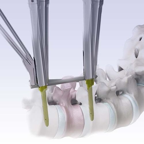 Мини-инвазивная система позиционирования педикулярных винтов - VENUS®mini 2.0 - HumanTech Dental