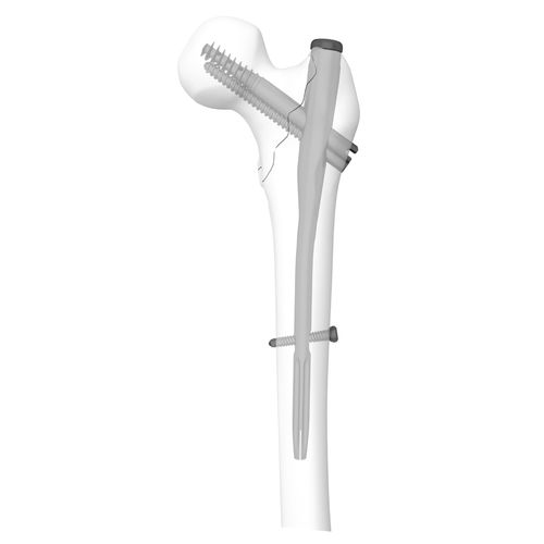 Интрамедуллярный штифт бедренная кость - 305030 series - Boneunion Medical - проксимальная фиксация / правый / левый