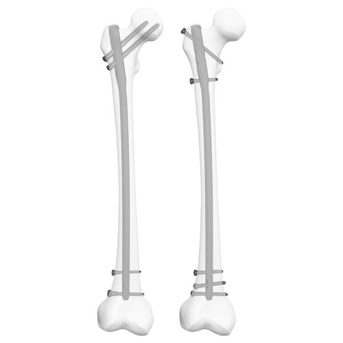 Интрамедуллярный штифт бедренная кость - 305009  - Boneunion Medical - проксимальная фиксация / дистальная фиксация / правый