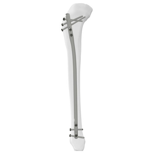 Интрамедуллярный штифт большеберцовая кость - 305014 series - Boneunion Medical - проксимальная фиксация / дистальная фиксация / правый