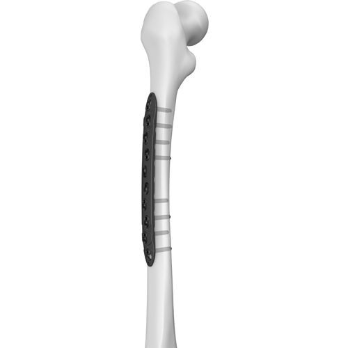 Компрессионная костная пластина бедренная кость - 301027 series - Boneunion Medical - медиальная / блокируемая / из титана