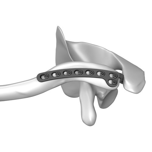 Компрессионная костная пластина для ключицы - 301007 series - Boneunion Medical - дистальная / блокируемая / из титана