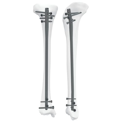 Интрамедуллярный штифт большеберцовая кость - 305050 series - Boneunion Medical - проксимальная фиксация / дистальная фиксация / правый