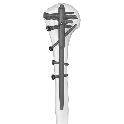 Интрамедуллярный штифт плечевая кость - 305077 series - Boneunion Medical - проксимальная фиксация / дистальная фиксация / правый