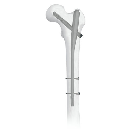 Интрамедуллярный штифт бедренная кость - 30500 series - Boneunion Medical - проксимальная фиксация / из титана