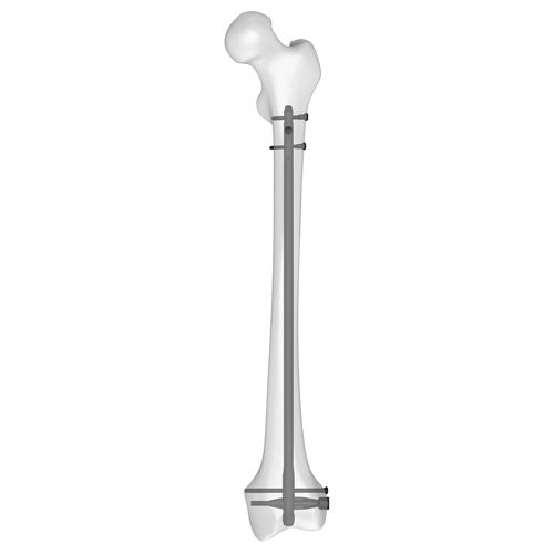 Интрамедуллярный штифт бедренная кость - 30510 series - Boneunion Medical - дистальная фиксация / правый / левый