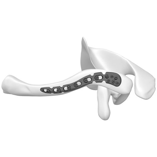 Компрессионная костная пластина для ключицы - 301055 series - Boneunion Medical - дистальная / блокируемая / из титана