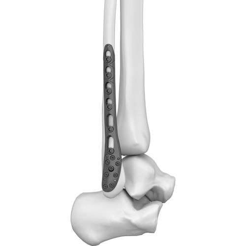 Компрессионная костная пластина малоберцовая кость - 301019 series - Boneunion Medical - дистальная / блокируемая / из титана