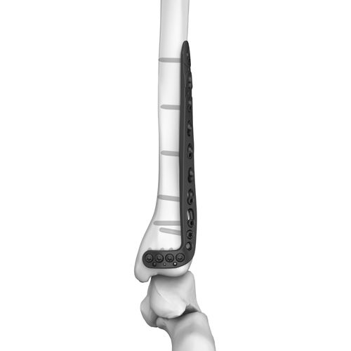 Компрессионная костная пластина большеберцовая кость - 301026 series - Boneunion Medical - дистальная / боковая / блокируемая