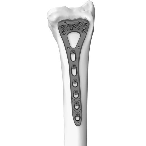 Компрессионная костная пластина лучевая кость - 301077 series - Boneunion Medical - дистальная / блокируемая / из титана