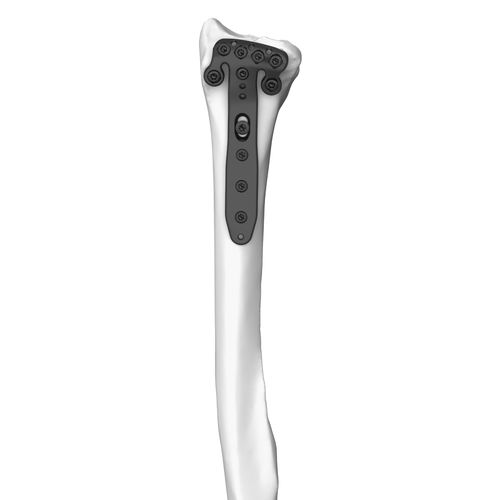 Компрессионная костная пластина лучевая кость - 30104 series - Boneunion Medical - дистальная / блокируемая / из титана