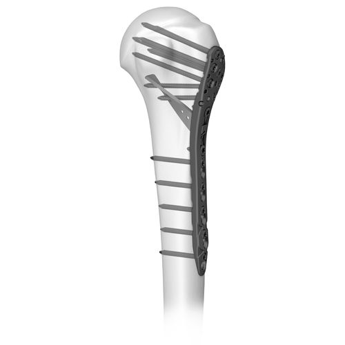 Компрессионная костная пластина плечевая кость - 301046 series - Boneunion Medical - проксимальная / блокируемая / из титана