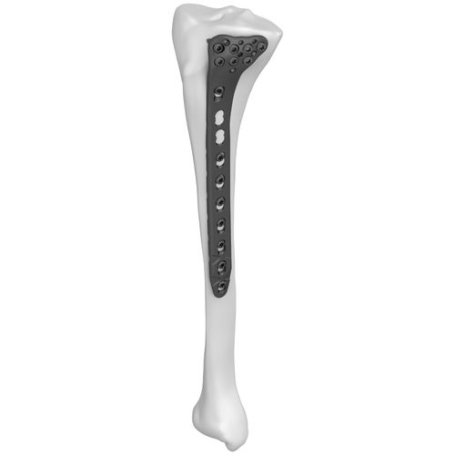 Компрессионная костная пластина большеберцовая кость - 301022 series - Boneunion Medical - проксимальная / боковая / блокируемая
