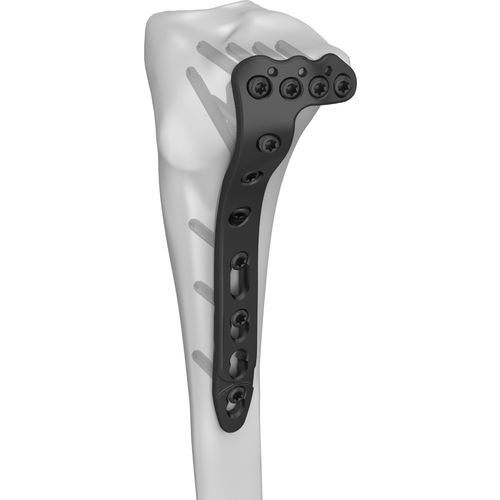 Компрессионная костная пластина большеберцовая кость - 301023 series - Boneunion Medical - проксимальная / боковая / блокируемая