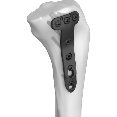 Компрессионная костная пластина большеберцовая кость - 301005 series - Boneunion Medical - проксимальная / медиальная / блокируемая