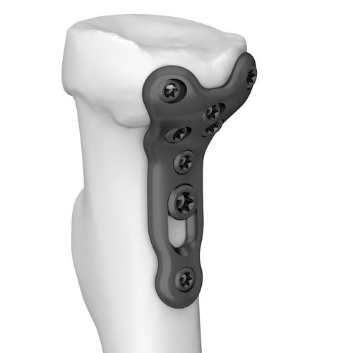 Компрессионная костная пластина лучевая кость - 301178 series - Boneunion Medical - для головки лучевой кости / проксимальная / блокируемая