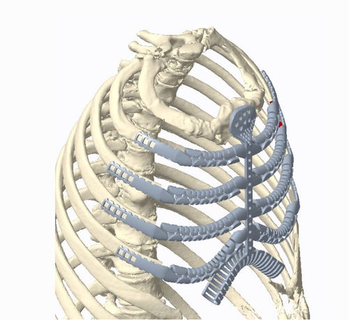 Грудной протез для восстановления после резекции остеосаркомы - Osteobionix