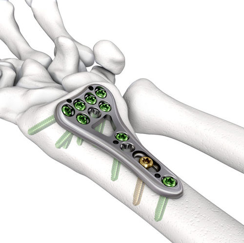 Компрессионная костная пластина лучевая кость - LOQTEQ® VA 2.5 - aap Implantate - дистальная / блокируемая / металлическая