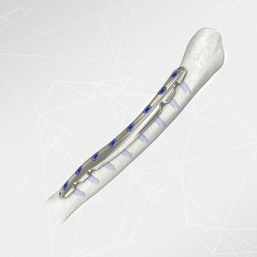 Компрессионная костная пластина для ключицы - LOQTEQ® 2.7 - aap Implantate - боковая / медиальная / блокируемая