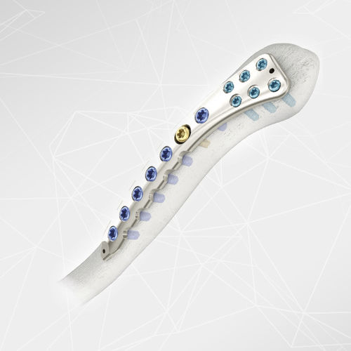Компрессионная костная пластина для ключицы - LOQTEQ® 2.7 - aap Implantate - боковая / блокируемая / металлическая