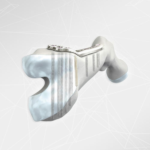 Компрессионная костная пластина бедренная кость - LOQTEQ® 4.5 - aap Implantate - дистальная / боковая / блокируемая