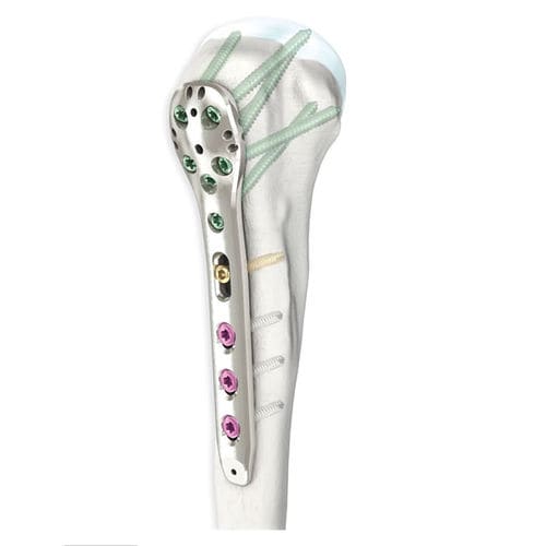 Компрессионная костная пластина плечевая кость - LOQTEQ® 3.5 - aap Implantate - проксимальная / блокируемая / металлическая