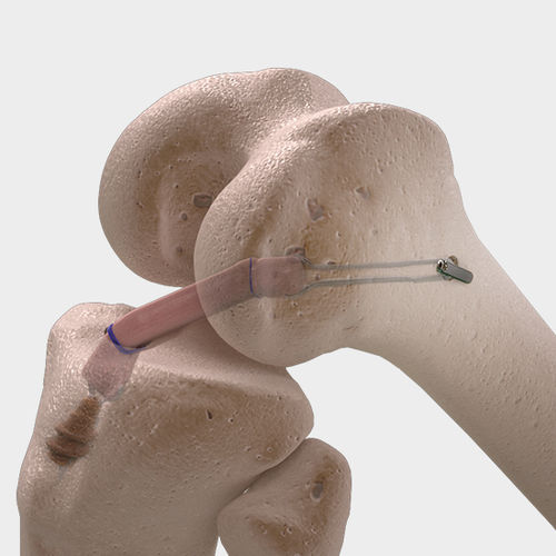 Лигаментарный протез передняя крестообразная связка - CorTTape® - FH Orthopedics - задняя крестообразная связка / синтетический