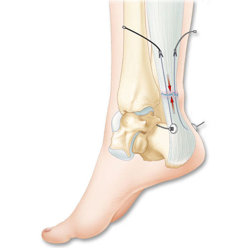 Лигаментарный протез ахиллова сухожилия - Tenolig® - FH Orthopedics - синтетический
