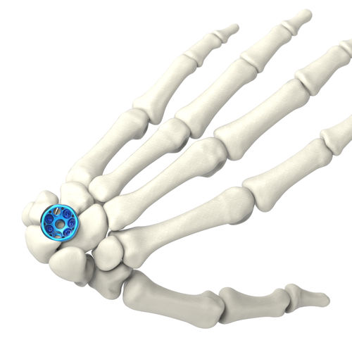 Костная пластина для артродеза для лучезапястного сустава - ARIX 2.5 - Jeil Medical Corporation - блокируемая / из титана