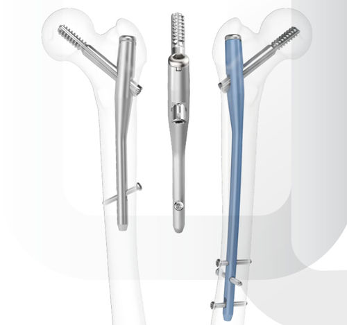 Интрамедуллярный штифт бедренная кость - ARIX - Jeil Medical Corporation - проксимальная фиксация / диафизарная фиксация / правый