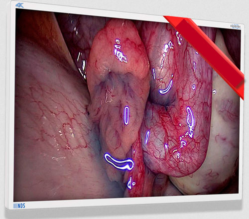 Медицинский монитор - EndoVue Plus - NDS Surgical Imaging - для эндоскопии / с высоким разрешением / 55"
