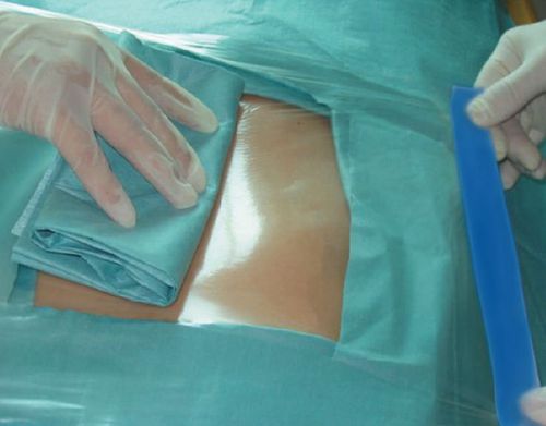 Операционное поле для общей хирургии - Incifilm® - Pharmaplast - для ортопедической хирургии / для кардиологической хирургии / для офтальмологической хирургии